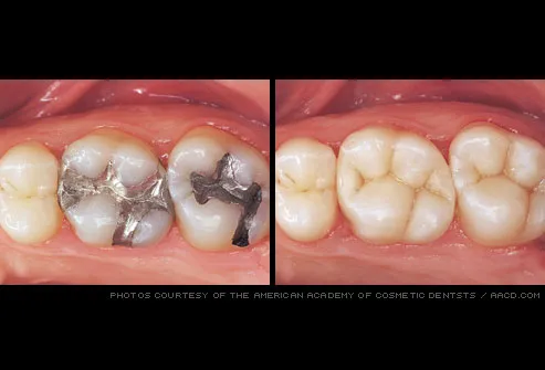 tooth-colored fillings replace amalgam fillings