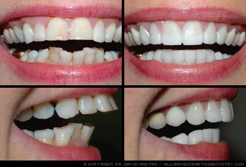 smile makeover corrects multiple dental problems