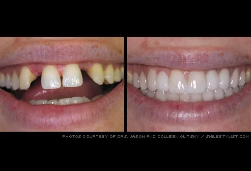 missing teeth restored with dental bridge