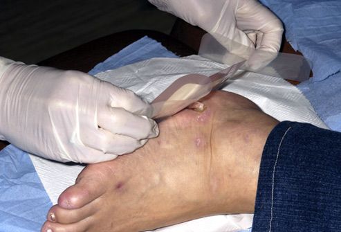 Doctor placing a dressing over a diabetic ulcer