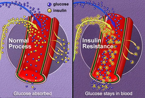Normal insulin absorption vs. insulin resistance