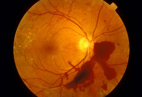 diabetic retinopathy with retinal hemorrhages