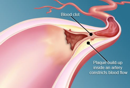 http://img.webmd.com/dtmcms/live/webmd/consumer_assets/site_images/articles/health_tools/diabetes_type-2_slideshow/webmd_illustration_of_plaque_in_artery.jpg