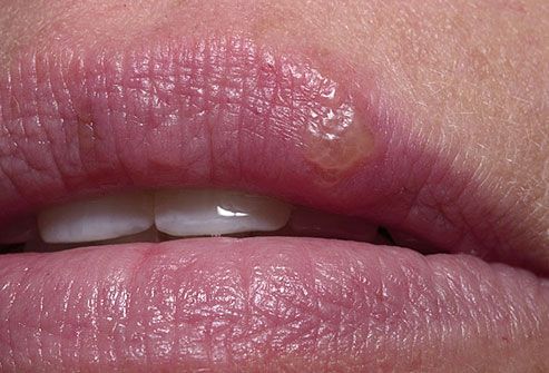 Ulcers & swollen glands - Mouth Ulcers.