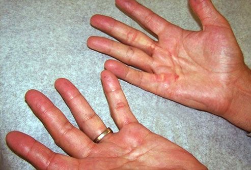 Shingles On Palm Of Hands