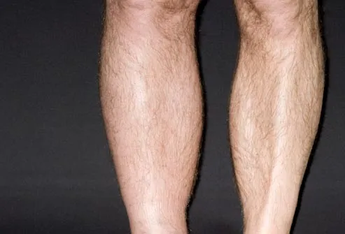 dvt in left leg of man