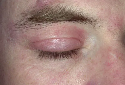 Rash Around Eyes - Causes, Treatment and Pictures