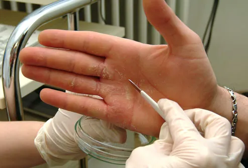 What are some common causes of rashes on hands and fingers?