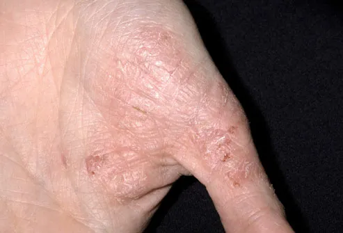 Steroid induced skin rash