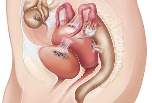 Illustration Of Endometriosis Symptoms
