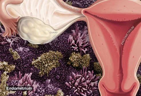 Illustration Of Endometriosis