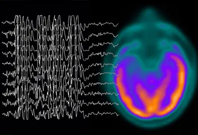 Brain scan and convulsion waves
