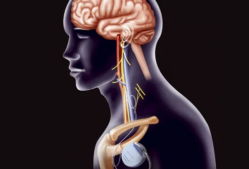 Illustration showing VNS implant