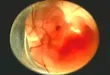 Human fetus in utero at 8 weeks