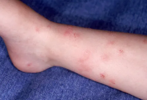 Allergic reaction to flea bites - TOODLE HUB