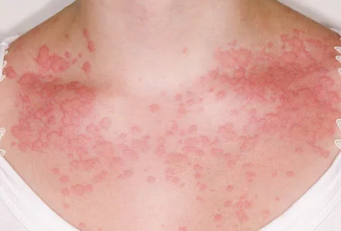 Skin rash from food allergy reaction