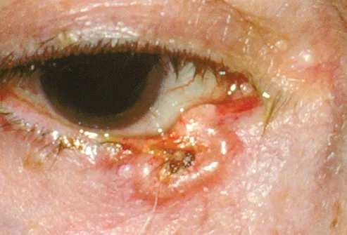 eyelid carcinoma close up