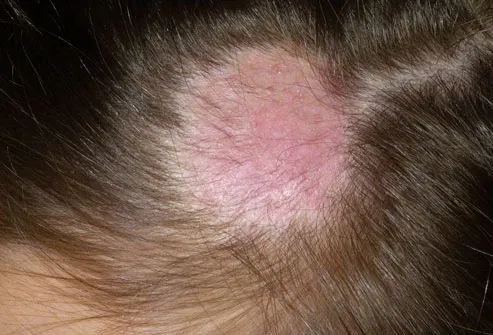 ringworm in hair pictures