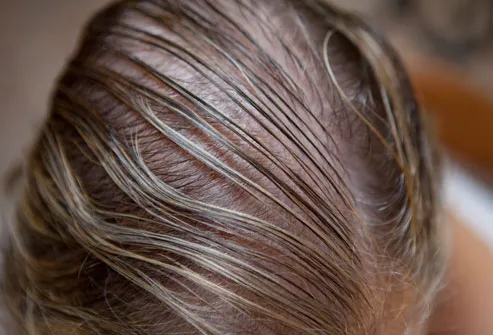 Top view of hair and scalp of woman with hair loss
