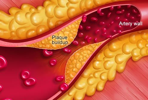 illustratino of plaque buildup in artery