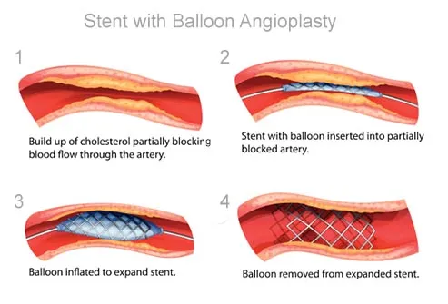 illustration of stent with balloon angioplasty