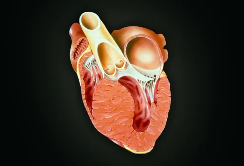 Illustration of hypertrophic cardiomyopathy