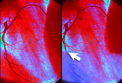 Angiogram menunjukkan infark miokard
