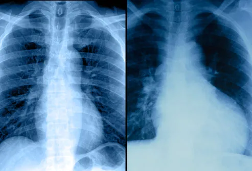 Chest x-ray showing enlarged left ventricle