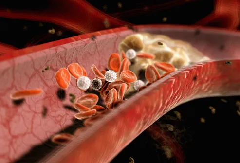 Ilustrasi dari penumpukan plak di arteri