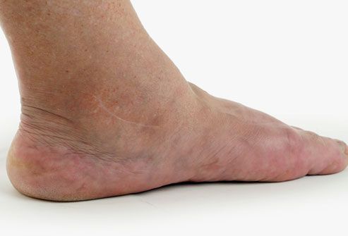 What are brown spots on top of feet called?