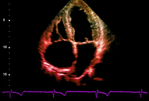 Heart ultrasound showing left ventricular hypertro