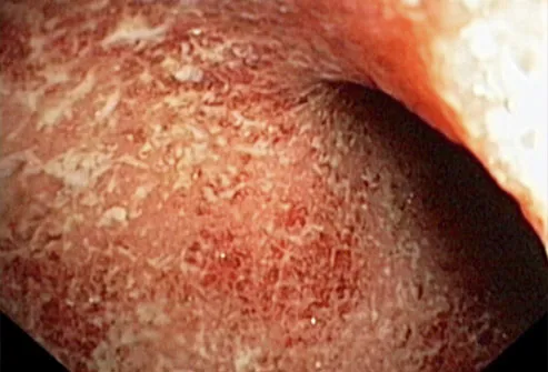 Ulcerative Colitis Of The Rectum
