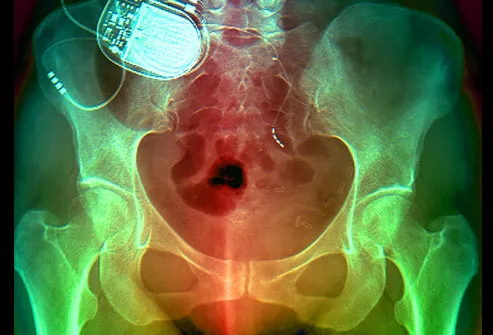 X-ray of pelvis showing implanted device