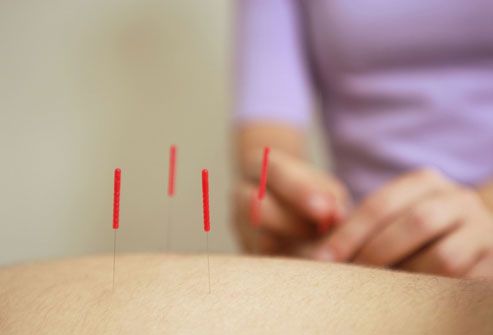 Acupuncture To Help With Infertility