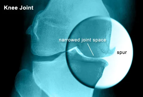 With overuse or injury, cartilage on the end of the joints can break down, 