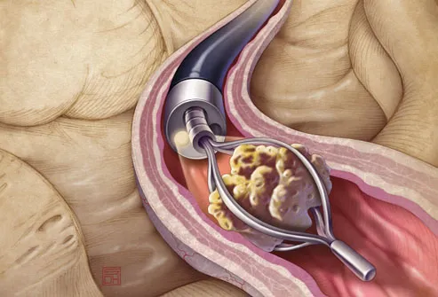 Illustration Of Ureteroscopy