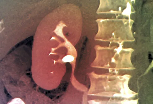CT Scan Showing Kidney Stone