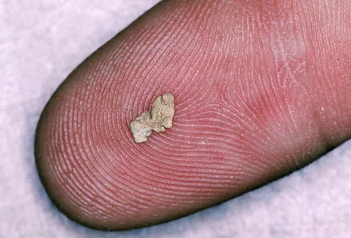 Kidney Stone On Finger