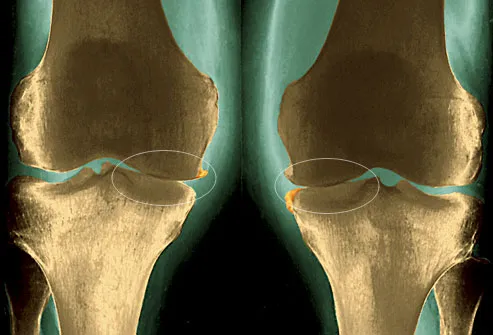 xray of osteoarthritis in knee
