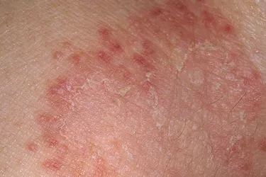 itchy burning patch of skin