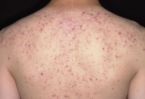 Acne due to steroids