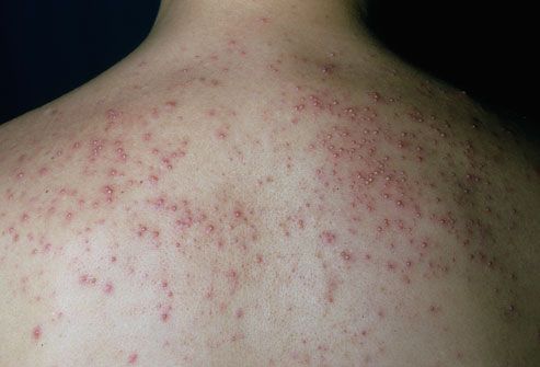 mild heat rash pictures. Heat rash is caused by blocked