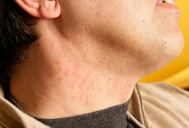 Patch Of Dry Skin On Neck Itch