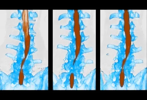 CT scan of spinal stenosis