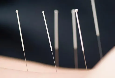 acupuncture needles in lower back