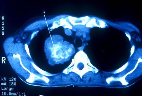 Coupling head and neck cancer screening and lung cancer scans could improve survival