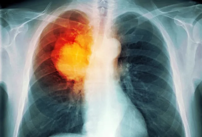 Color Xray Showing Lung Cancer