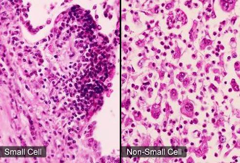 Small cell carcinoma   wikipedia