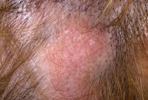 Causes of a Rash on the Scalp Skin | LIVESTRONG.COM