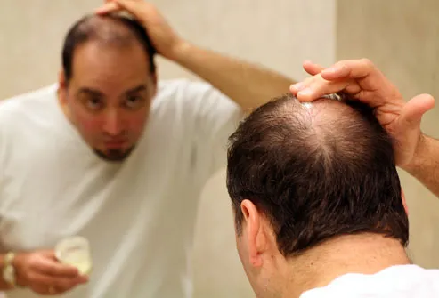 Men's Hair Loss: Treatments and Solutions With Pictures